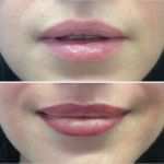 Einverständniserklärung Vorlage Permanent Make Up Hübsch Lippenkontur Mit Schattierung Permanent Make Up